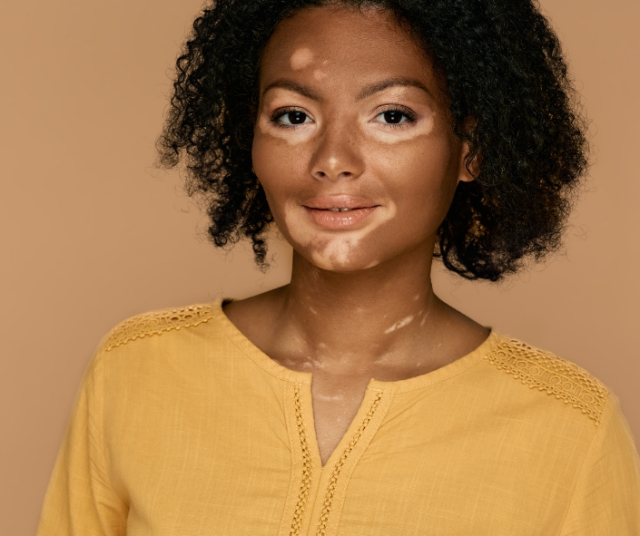 Qu’est-ce que le vitiligo ? Traitement et sensibilisation