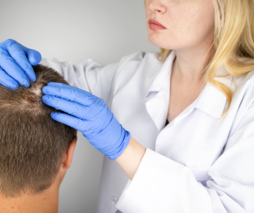 Alopecia | Los mejores tratamientos para tratar la calvicie