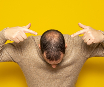 ¿Qué es la alopecia? - Tratamientos y consejos