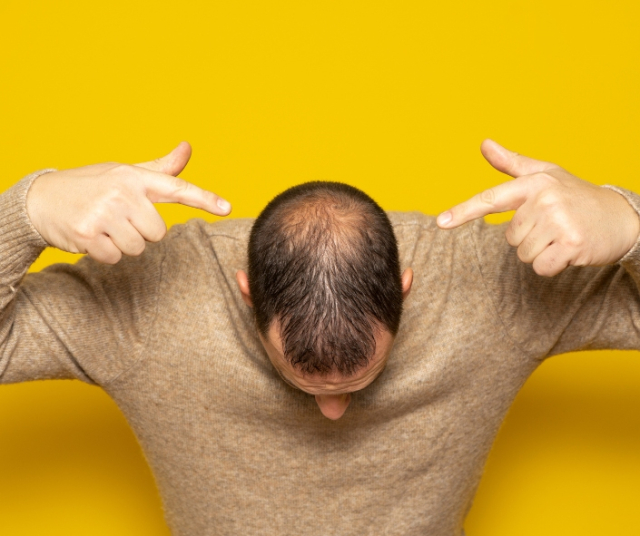 What is alopecia? - Treatments and advice 