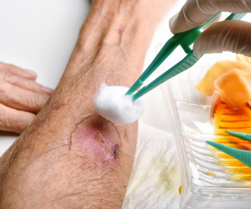 How to disinfect wounds and burns? 
