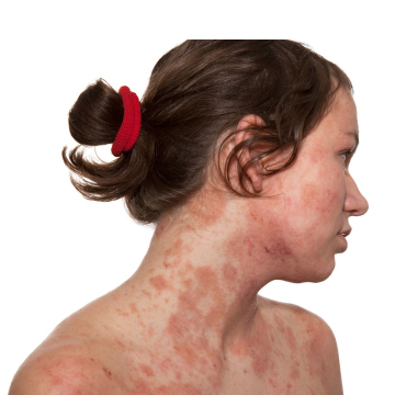 Dermatitis: Todo lo que debes saber